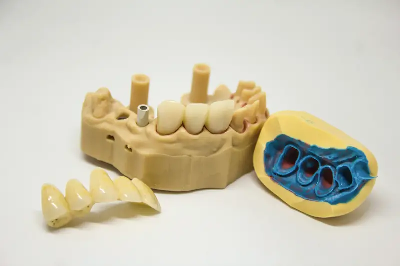 Zahntechnisches Modell mit Implantaten und Brücke